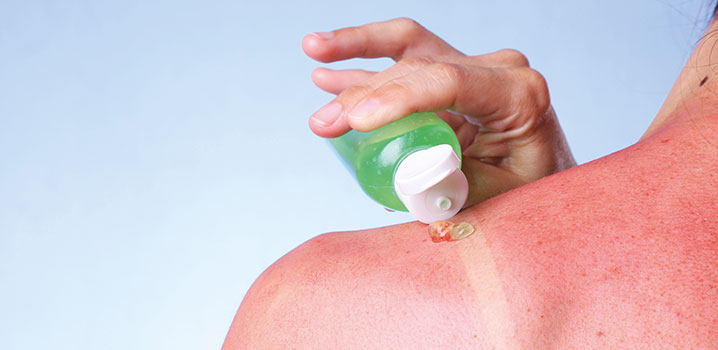 Sonnenbrand Selbsthilfe - After-Sun-Produkte nutzen