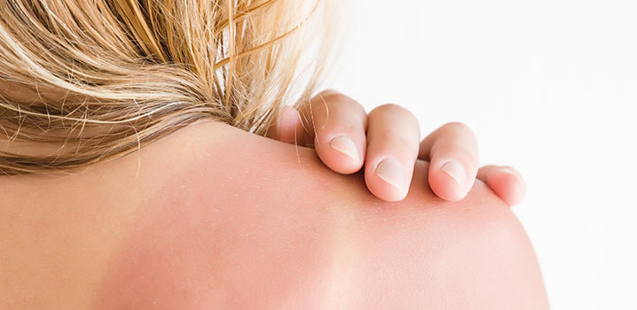 Sonnenbrand Selbsthilfe - raus aus der Sonne
